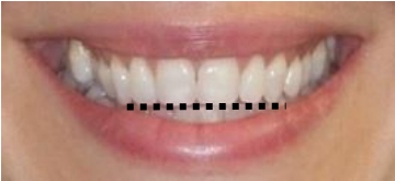 The Well Detailed Smile Smile Arc Advances In Orthodontics