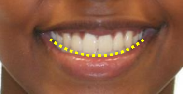 The Well Detailed Smile Smile Arc Advances In Orthodontics