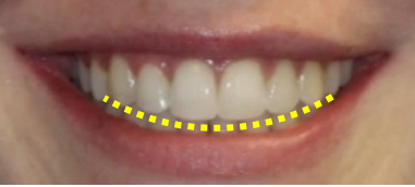 The Well Detailed Smile Smile Arc Advances In Orthodontics