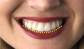 The Well Detailed Smile Smile Arc Advances In Orthodontics