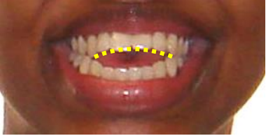 The Well Detailed Smile Smile Arc Advances In Orthodontics