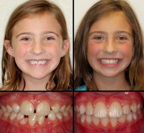 Golden Valley Orthodontics | Plymouth MN Orthodontics | St Louis Park ...